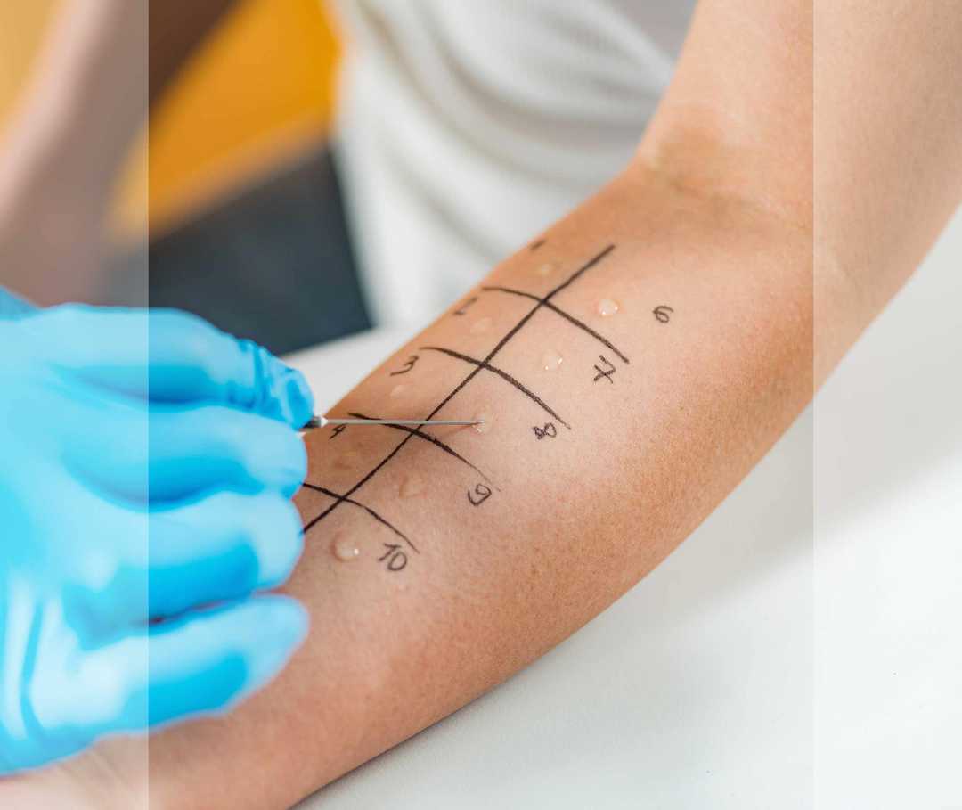 Mit einem Provokationstest am Unterarm wird ein Patient auf Allergien überprüft.